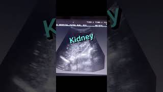 Echogenic Kidney shorts youtube viral [upl. by Schilit]