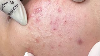 ACNE TREATMENT VU QUYNH MI Acne On Boys Chin 2024 [upl. by Louanne593]