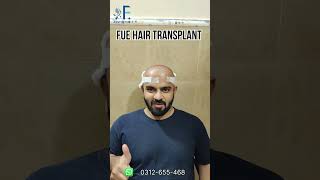 Hair Fall Treatment  DHI  FUE Hair Transplant  Dr Faisal Hayat Khan  FAesthetics [upl. by Lavine]