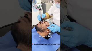 Treatment for acne pits and scarsmicro needling therapy skincare shorts viral drrichadubey [upl. by Kappel245]