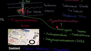 Acne Vulgaris Part 3 [upl. by Ahsienyt]