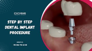 Step by Step Dental Implant Procedure [upl. by Analla]