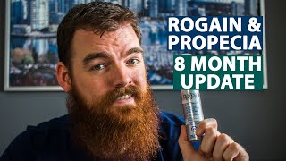 Minoxidil Results  8 Months Using Rogaine amp Propecia [upl. by Nauqram157]