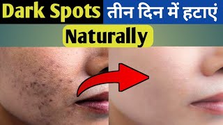 Dark Spots on Face Removal  Dark Spots kaise hataye  Dark Spots Removal [upl. by Cadmar]