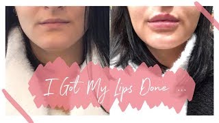 I GOT LIP FILLERS  Getting 1ml of Juvederm Volift  beckyloubutton [upl. by Noillimaxam57]