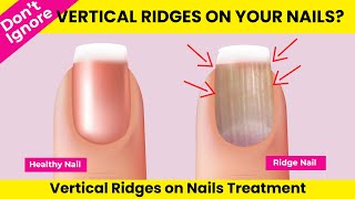 Don’t Ignore if Vertical Ridges on Your Nails English  Vertical Ridges on Nails [upl. by Anomar246]