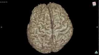 Variation of brain cortex 3D MRI sample Bgo [upl. by Nnalatsyrc]