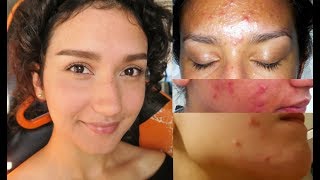 How I FINALLY cleared my acne NATURALLY  What caused my acne [upl. by Rolland]