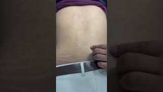 Dryneedling therapy for back pain dryneedling ytshorts backpain physiotheraphy terenaina [upl. by Soirtemed932]