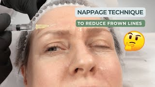 Mastering the Mesotherapy Nappage Method [upl. by Atnwahs575]