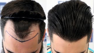 FUE Hair Transplant 2491 Grafts NW III A By Dr Juan Couto  FUEXPERT CLINIC Madrid Spain [upl. by Jewell79]