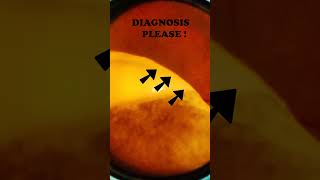 Diabetic retinopathy  Vitreous  Hard exudates  Fundus  Short Video 195 [upl. by Suivatnom]