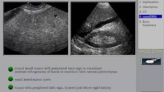 Ultrasound of the Liver HCC 1 in Arabic أورام الكبد [upl. by Tierza]