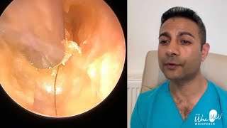 1509  Chronic Bacterial Ear Infection  Eardrum Anatomy and Eustachian Tube Function Explained [upl. by Rinum195]