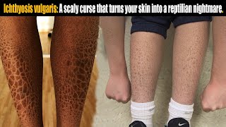 Ichthyosis vulgaris A scaly curse that turns skin into reptilian nightmare [upl. by Ahs]