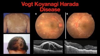 VogtKoyanagiHarada Disease VKH  Swelling of the Eye and the Body [upl. by Nohshan]