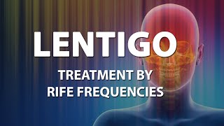 Lentigo Skin  RIFE Frequencies Treatment  Energy amp Quantum Medicine with Bioresonance [upl. by Allemac]