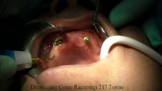 Implantologia Sup Full Arc Piezo Surgery Dr Floriano Petrone [upl. by Honor]