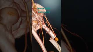 CT lower limb aneurysmctangiography ctscan ctcontrst medical ctscan trauma [upl. by Idell266]