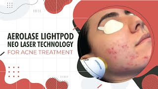 Aerolase LightPod Neo Laser Technology for Acne Treatment  Beverly Hills CA [upl. by Fairley]