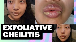 Exfoliative Cheilitis  Ointments amp Creams  Short Chitchat [upl. by Fredelia]