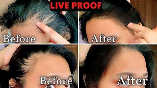 3 MONTHS HAIR REGROWTH UPDATE⚠️Grow your hairline back with Mars by GHC hair vitalizer hair serum [upl. by Aimar]