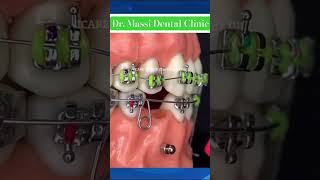 TaDs for BRACES youtubeshorts youtube viral [upl. by Jed687]