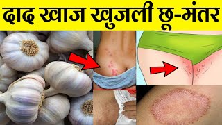 जाँघो के बीच दाद खाज खुजली 3 दिन में छूमंतर  fungal infection treatment at home daad khaj ka ilaj [upl. by Ydassac]