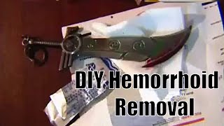 DIY Hemorrhoid Removal [upl. by Bridgid813]