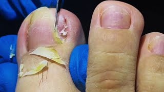 Relief in Minutes Fixing Ingrown Toenail and Toenail Fungus Surgery [upl. by Eanerb]