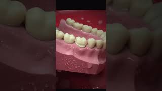 Dental crown preparation part 2 proximal surface reduction teeth teethstreet dental dentaltip [upl. by Ariaet]