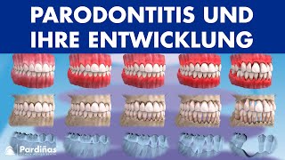 Zahnfleischentzündung Parodontitis und ihre Entwicklung © [upl. by Karlyn]