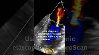 Meet the FibroScan [upl. by Asp]