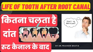 कितना चलता है दांत रुट कैनाल के बादLIFE of tooth after RCT rootcanaltreatment bhatiadentopulse [upl. by Ellinger660]