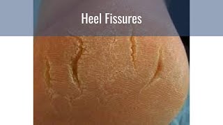 How to Treat PAINFUL CRACKS in your heels [upl. by Migeon]