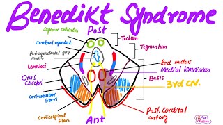 Benedikt syndromeMade easy for USMLEPlabFCPS medicine [upl. by Amalea]