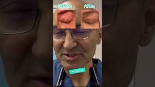 JOURNEY OF BLEPHAROPLASTY  DR TANVEER JANJUA NEW JERSEY [upl. by Shaylah]