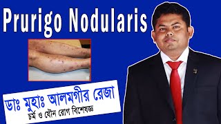 Prurigo Nodularis চিকিৎসা ও সঠিক ব্যবস্থাপনা  ডা আলমগীর রেজা  প্রুরিগো নোডুলারিস চিকিত্সা [upl. by Issak]