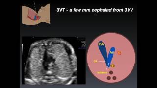 Three Vessel Tracheal View A Review of Normal and Abnormal Findings [upl. by Ursa]