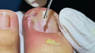 Removing Infected Ingrown Toenails [upl. by Raybin]