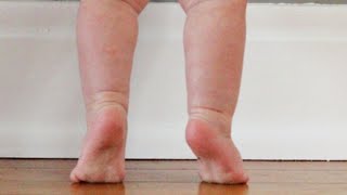 Case 593 How to approach evaluate intoeing In children in toe waking pigeon feet contractureDMD [upl. by Ibib]