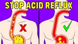 The 4 minute natural trick to prevent acid reflux in the oesophagus [upl. by Shaylah]