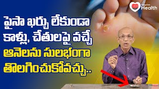 Corns  పైసా ఖర్చు లేకుండా కాళ్లు చేతులపై వచ్చే ఆనెలను Dr Ch Madhusudana Sarma  TeluguOne Health [upl. by Bunow191]