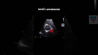 lambls excrescences echocardiography sonography aortic valve 심장초음파 heart cardiology [upl. by Bondy414]