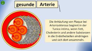 Herzinfarkt  Arteriosklerose Konsequenzen Symptome Risikofaktoren [upl. by Nevaeh]