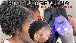 MICRONEEDLING  PRP FOR EDGE GROWTH 💉 FULL PROFESSIONAL JOURNEY  TRACTION ALOPECIA 🚨  FAQ [upl. by Selec225]