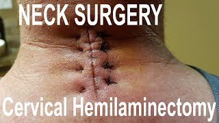 Neck Surgery Cervical Hemilaminectomy [upl. by Cullen]