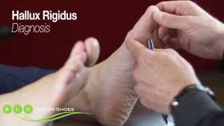 Hallux Rigidus Causes Diagnosis and Treatment [upl. by Bendicty]