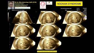 Noonan Syndrome [upl. by Sirob687]