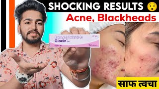 Glocin Gel Review  Best Cream For Acne Pimples Blackheads [upl. by Aelanna]